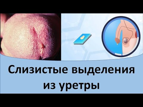 Слизистые выделения из уретры. Слизь в уретре у мужчин.