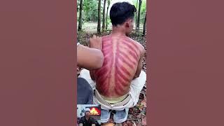 Kerokan masuk angin parah #kerokan #damam #refreksi #demam #senak #mual #meriang #muntah #flu #demam