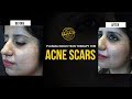 Plasma induction therapy for acne scar  dr nivedita dadus dermatology clinic