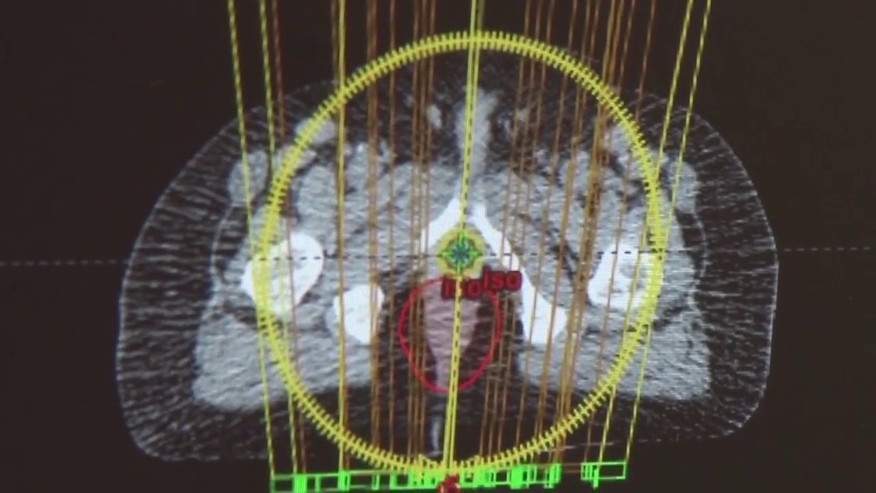 Radiation Oncology Treatment (Spanish) neurology department