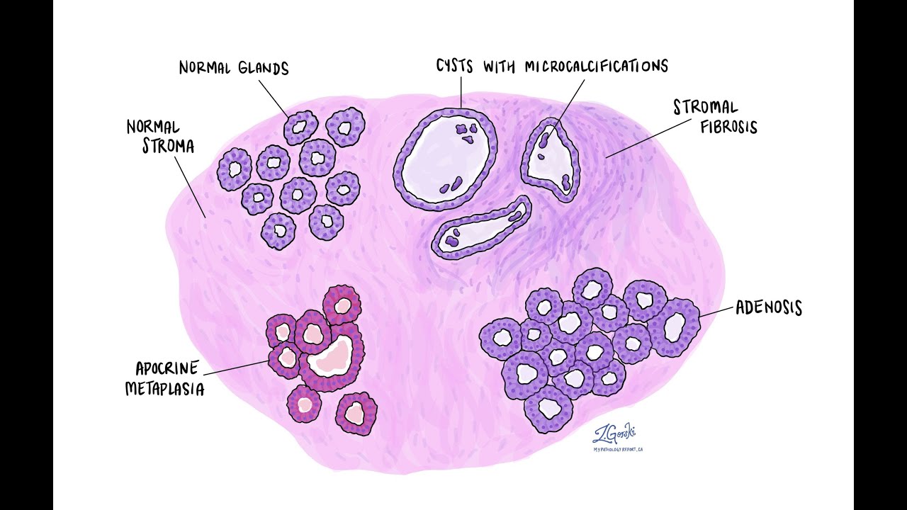 Случай 180. Хромогенная гибридизация in situ