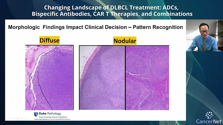 Changing Landscape of DLBCL Treatment: ADCs, Bispecific Antibodies, CAR T Therapies and Combinations