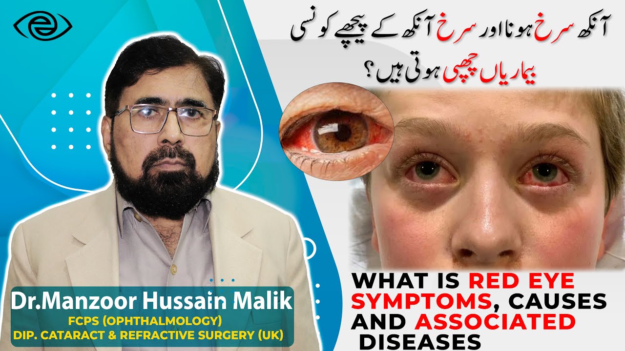 Red Eye Symptoms, Causes and Associated Diseases Urdu/Hindi YouTube