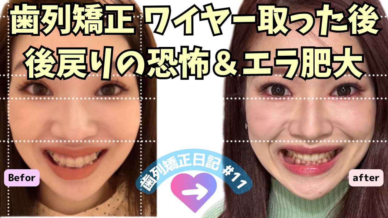 【歯列矯正日記#11】3年の歯列矯正の後戻り怖過ぎて！ブラオフから保定期間3ヶ月目の経過