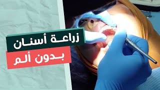 كيف تتم عملية زراعة الاسنان من الالف الي الياء  (بدون ألم) | د/معتز الشوبري