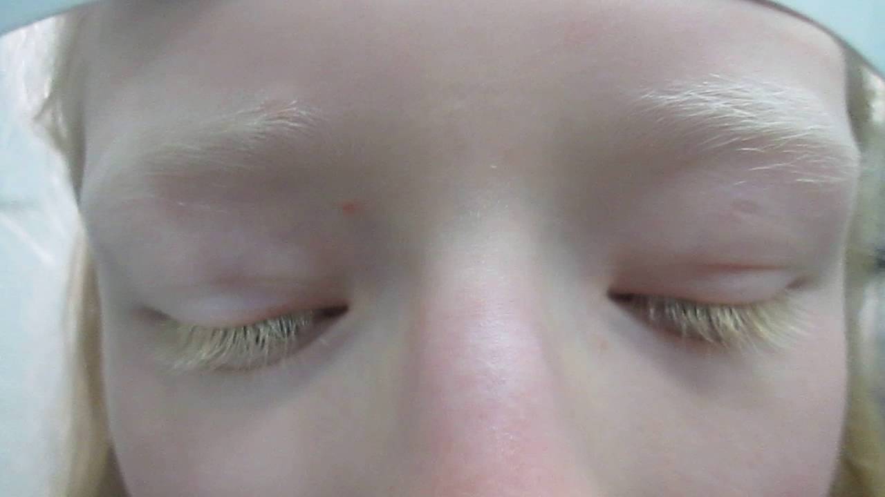 Ojos Inusuales: Respuestas sobre Albinismo, image size:1280x720