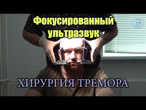 Фокусированный ультразвук (ФУЗ) - малоинвазивная операция. Хирургическое лечение болезни Паркинсона.