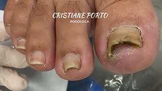 😱| ESSE ANTES X DEPOIS VAI TE IMPRESSIONAR. QUE RESULTADO INCRÍVEL ! #podologia #satisfatório 
