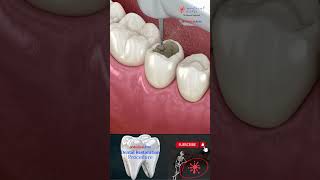 How Dental Implants Work Inside Your Jawbone