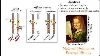 USMLE ACE Video 28: Genetic Terminologies, Angelman and Prader-Willi Syndromes