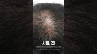 정수리탈모 붉은두피 모낭주사 10회 전후