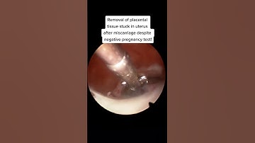 Removal of placental tissue remnant after miscarriage