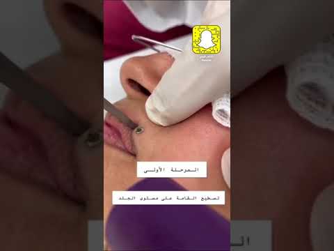 فيديو: كيفية إزالة الشامات بدون جراحة (بالصور)
