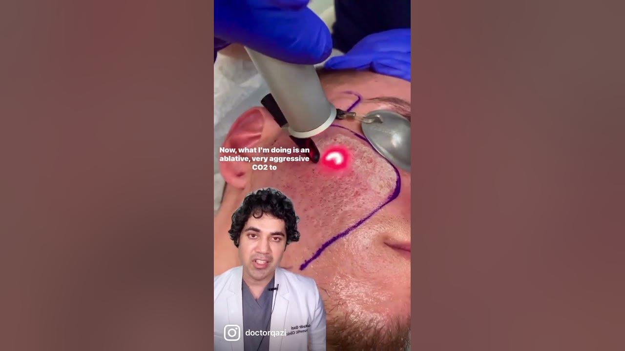 the-best-way-to-treat-deep-acne-scars-youtube