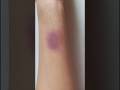 How To Create Fake Bruises Fake Injury Trending Sfx Sfxmakeup Bruises Fakecut Fakeinjury How To Create Fake Bruises Fake Injury Trending Sfx Sfxmakeup Bruises Fakecut Fakeinjury