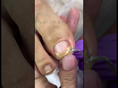 Видео: 4 начина за премахване на лак за нокти от кожата