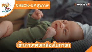 เช็กภาวะตัวเหลืองในทารก | CHECK-UP สุขภาพ