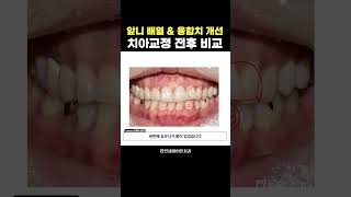 앞니 배열 &amp; 융합치 개선 치아교정 전후비교