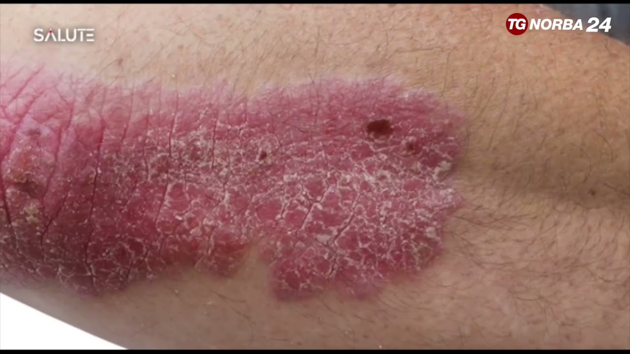 Bimekizumab mette la psoriasi in fuori gioco