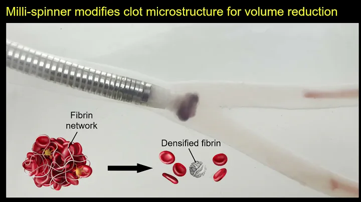Removing blood clots with milli-spinner