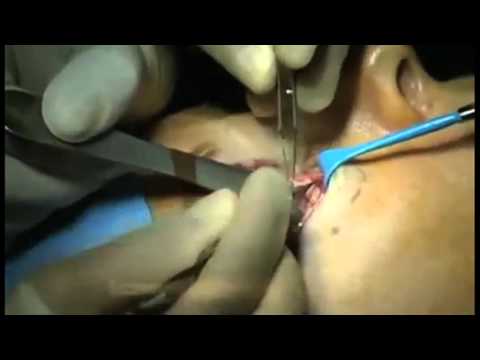 Cosmetic Eyelid Surgery - YouTube