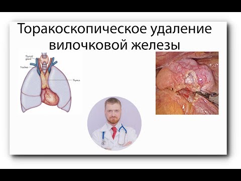 УДАЛЕНИЕ ТИМОМЫ | ТИМУС | ОПУХОЛЬ ВИЛОЧКОВОЙ ЖЕЛЕЗЫ
