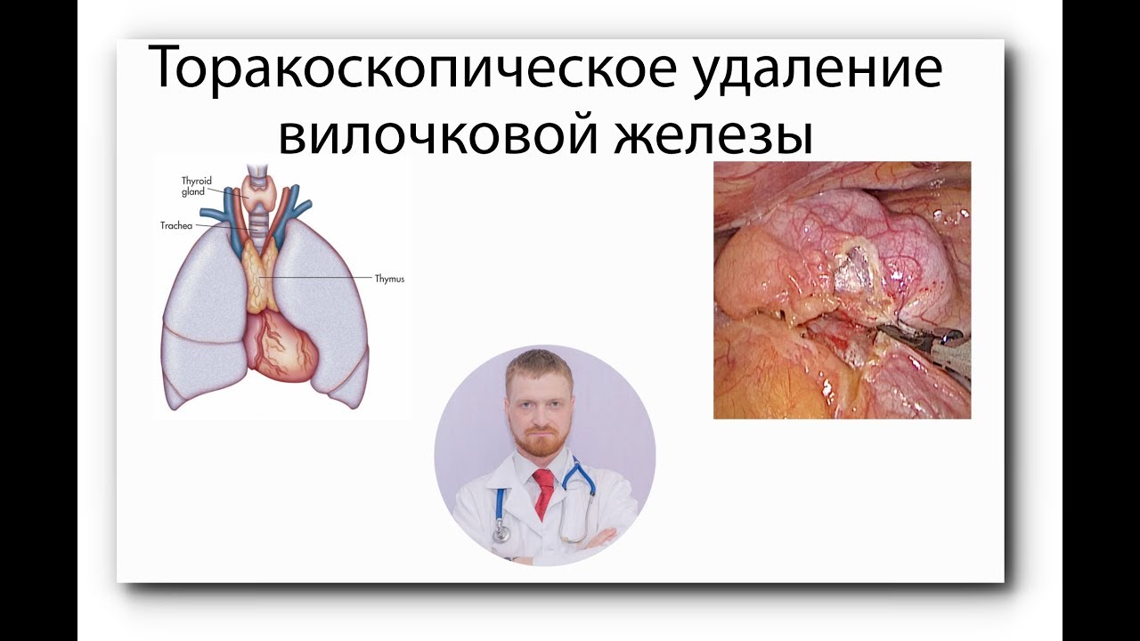 УДАЛЕНИЕ ТИМОМЫ | ТИМУС | ОПУХОЛЬ ВИЛОЧКОВОЙ ЖЕЛЕЗЫ