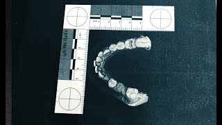 Celebrity Convictions questioned as forensic bite mark analysis now considered by some to be 'junk science' Profile