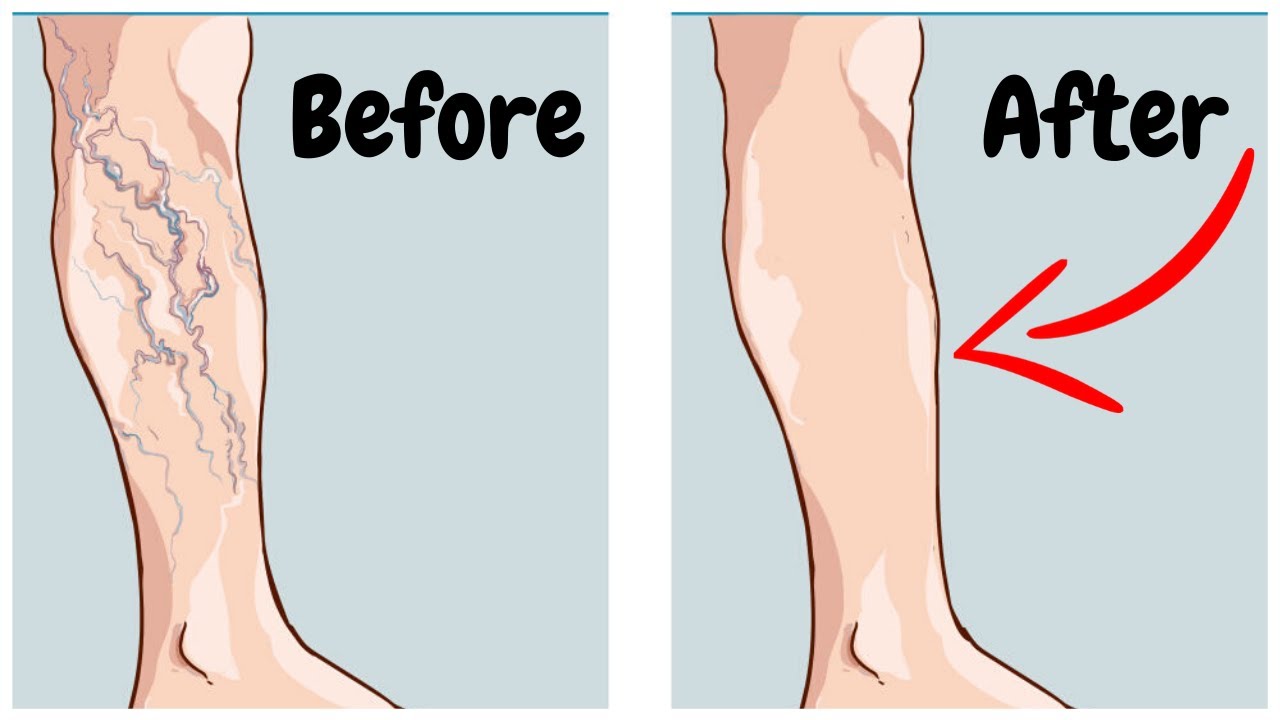 BEST Home Remedies For Varicose Veins In Your Legs | Treat Varicose