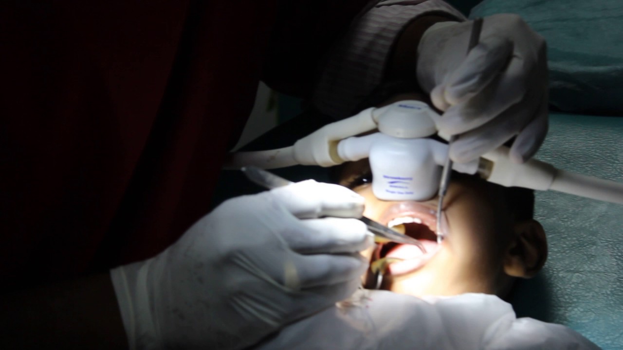 NOISnitrous oxide inhalational sedation YouTube