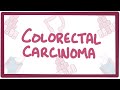 Colorectal carcinoma - causes, symptoms, diagnosis, treatment, pathology