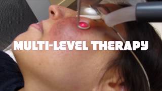 Treatment of dermal melasma using the picoway laser. The Spinning Wheel Method by Dr David Njoo