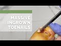 TWO massive INGROWN nails from teenager RIPPING his nails for 18 YEARS