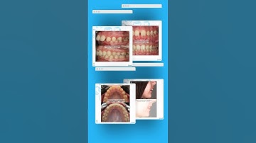 Mandibular Advancement Case with Clear Aligners..Let’s free your smile.#klinik45 #invisalign