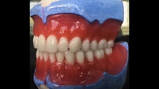 Total Protezlerde Diş Eti ModelajıWax Contouring of Complete Denture