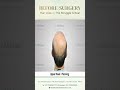 Amazing Hair Transplant Result in Patna 🔥 | Latest FUE Technique #shorts #viral #hair