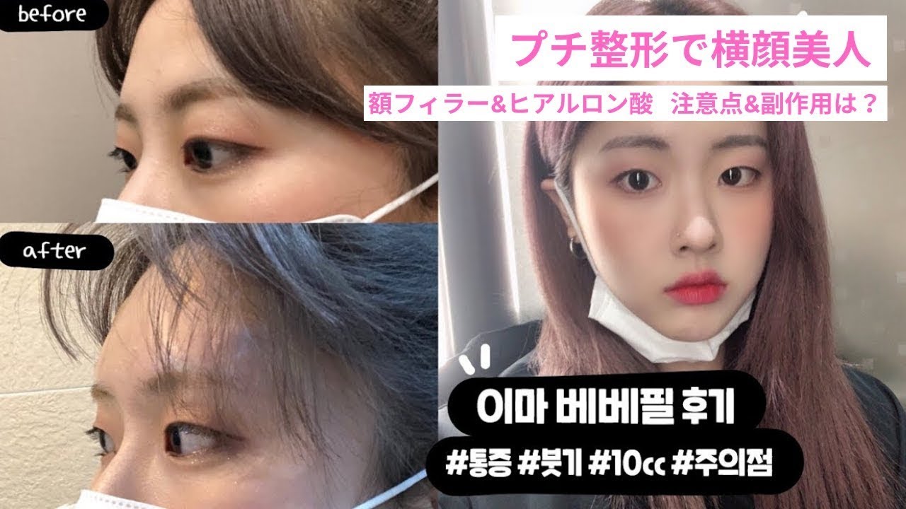 横顔ブサイクさよなら 韓国美女のおでこフィラー ヒアルロン酸体験 注意点や副作用は Youtube