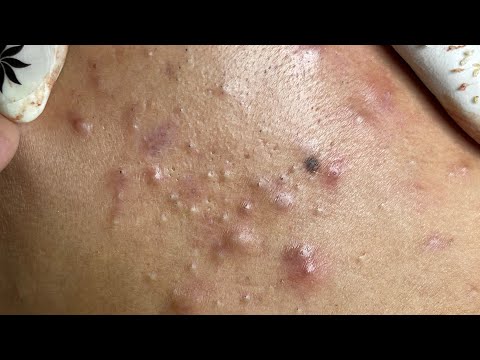 Video Relaxing Acne Treatment #159(Linh My Dang)P2 - youtube