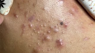Relaxing Acne Treatment #159(Linh My Dang)P2