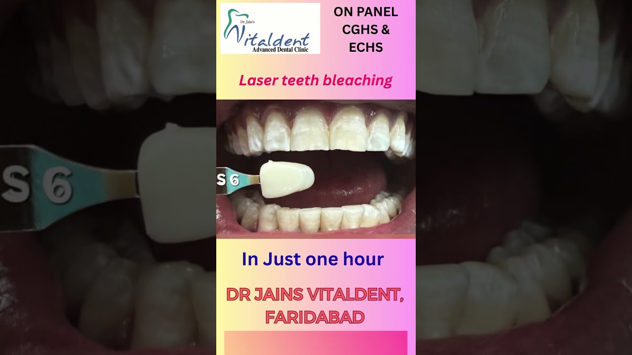 Tooth Bleaching / Whitening-Dr Vishal Jain 