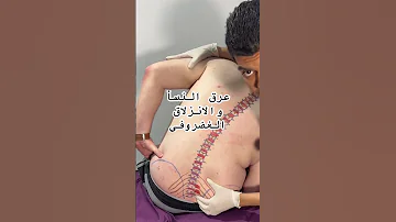عرق النسأ والانزلاق الغضروفى دكتور محمد علاء 