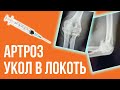 АРТРОЗ ЛОКТЕВОГО СУСТАВА! УКОЛ ГИАЛУРОНОВОЙ КИСЛОТЫ В ЛОКОТЬ!