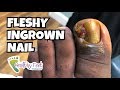 Fleshy Ingrown Toenail Removal.