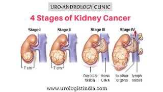 Kidney Cancer Treatment In Chennai Kidney Cancer Symptoms, Tamil Nadu Best Urologist In India