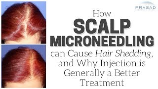 How Scalp Microneedling can Cause Temporary Hair Shedding, and Advantages of Injection Treatment