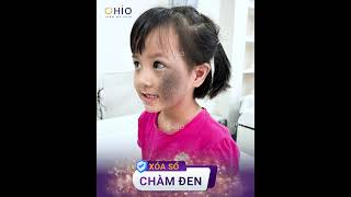 Xóa sạch chàm bớt cho con tự tin đến trường