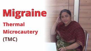 Best Ayurveda treatment for Migraine, Headache | Thermal Microcautery | Agnikarma