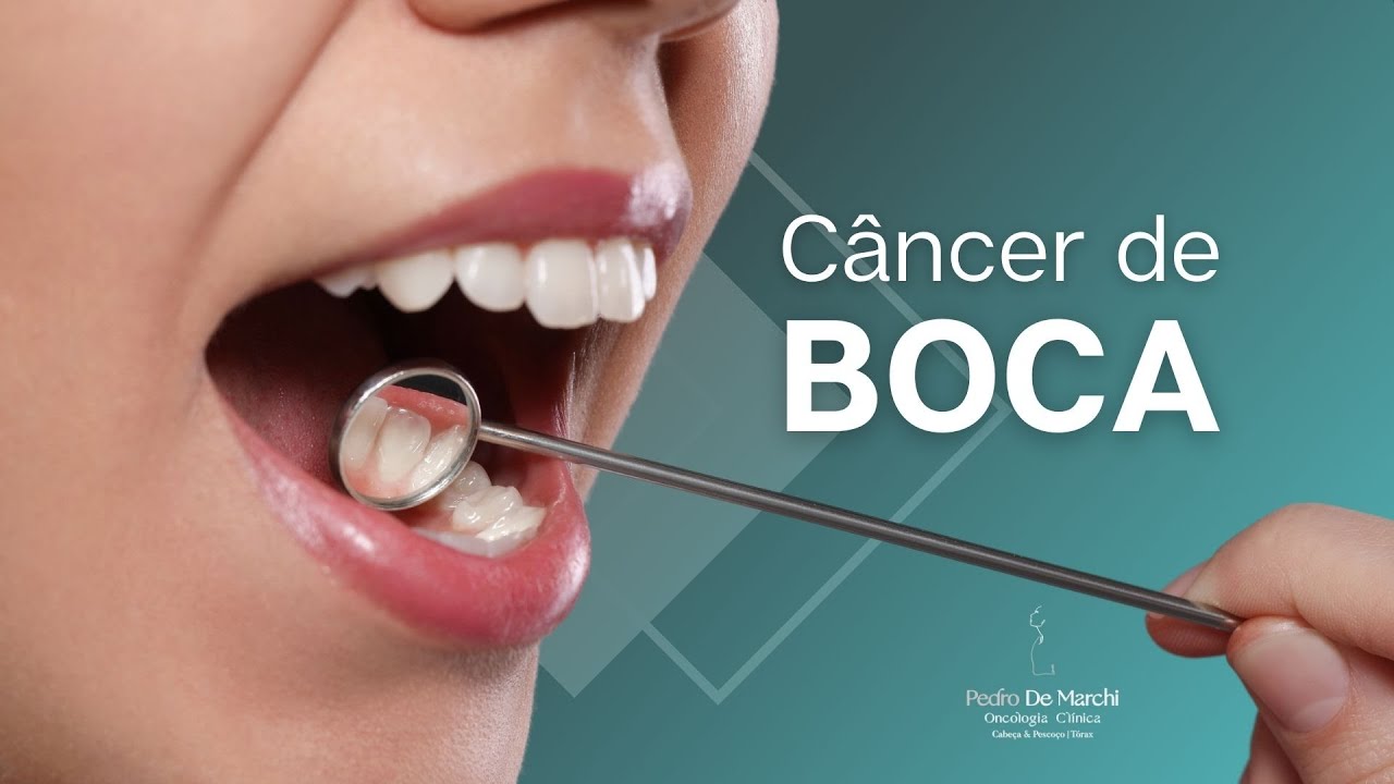 Câncer de boca - conheça tudo sobre essa doença - YouTube