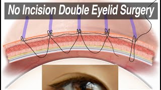 NonIncisional Asian Double Eyelid Surgery (Suture Technique for Monolid Correction) Animation