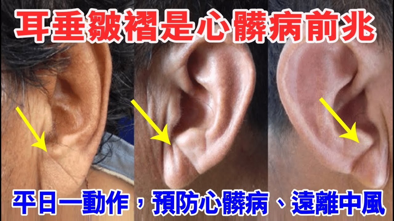 耳垂皺褶是心髒病前兆！平日多做一動作，預防心髒病、遠離中風！為了健康，一定要知道！ - YouTube